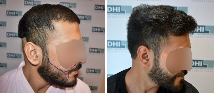  beard hair transplant results